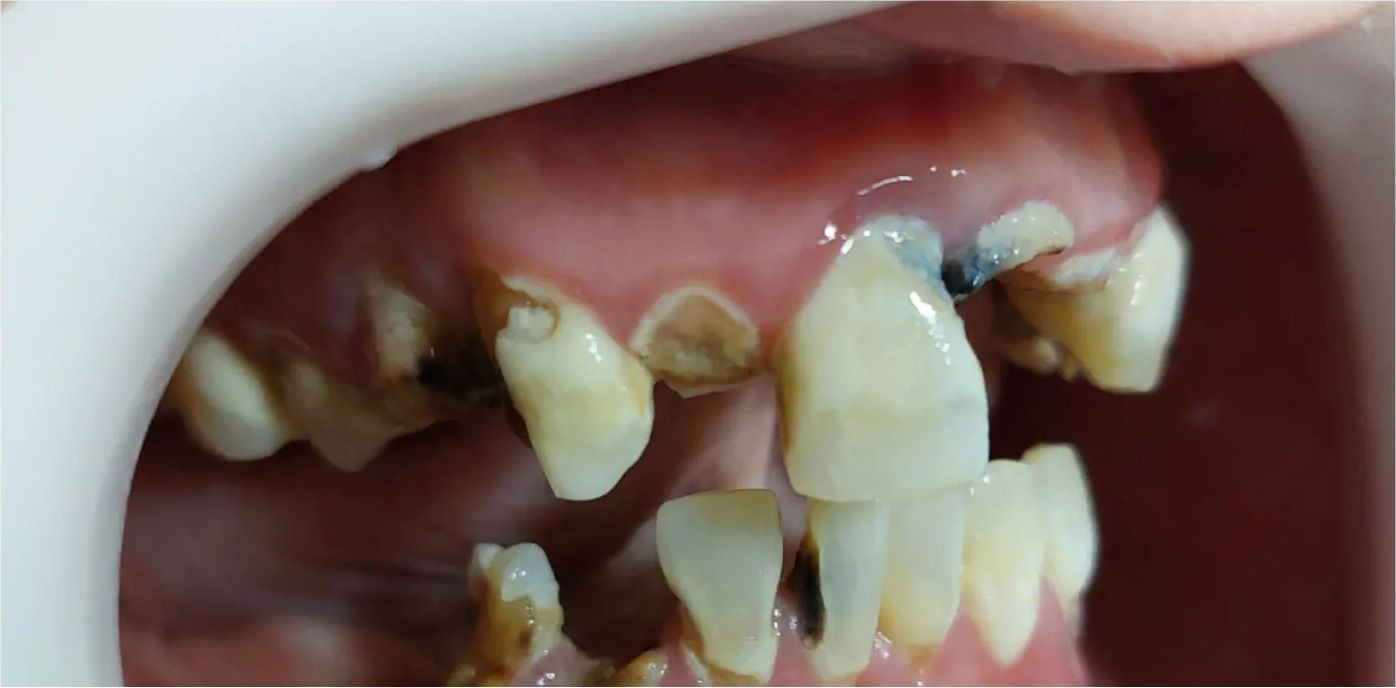 Before: severely damaged teeth