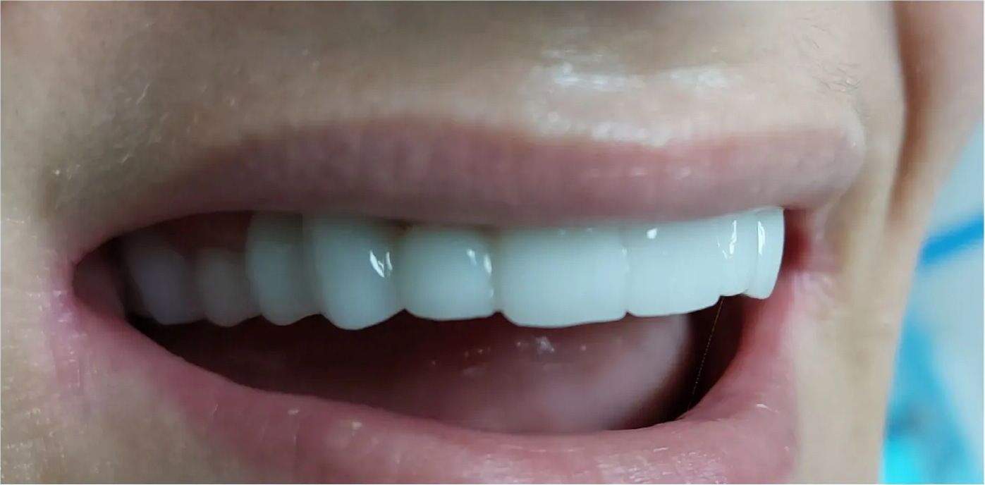 After: the restored smile