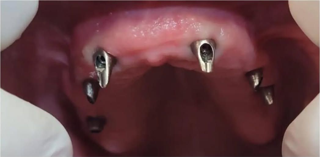 Implants placed: an upper jaw with implants in place