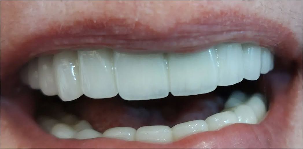 After: the fixed full-arch restoration