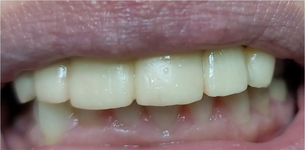 Before: the upper teeth before treatment
