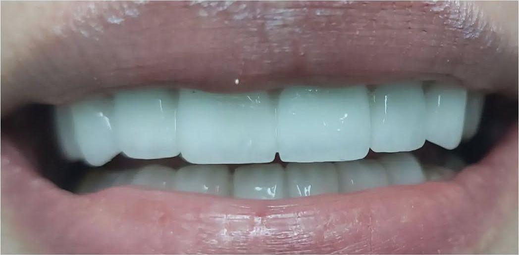 After: after treatment