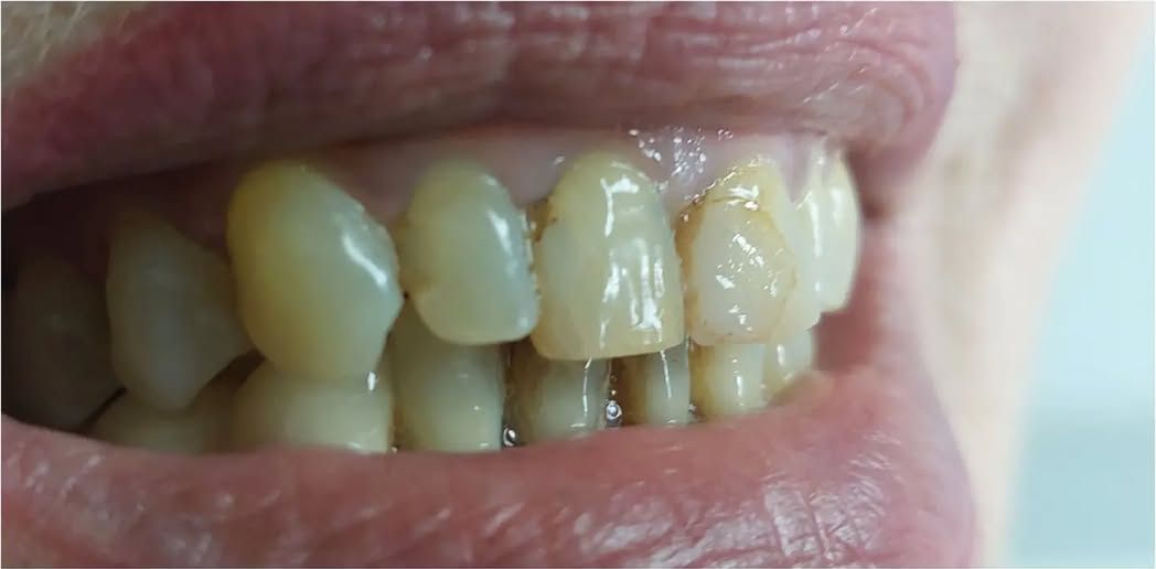 Before: a worn, discoloured smile