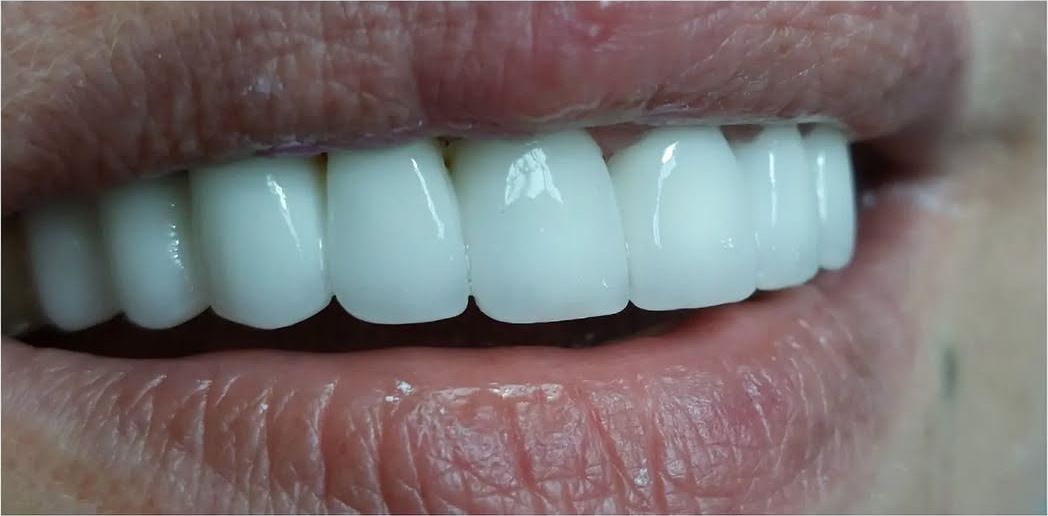 After: the same smile after restoration