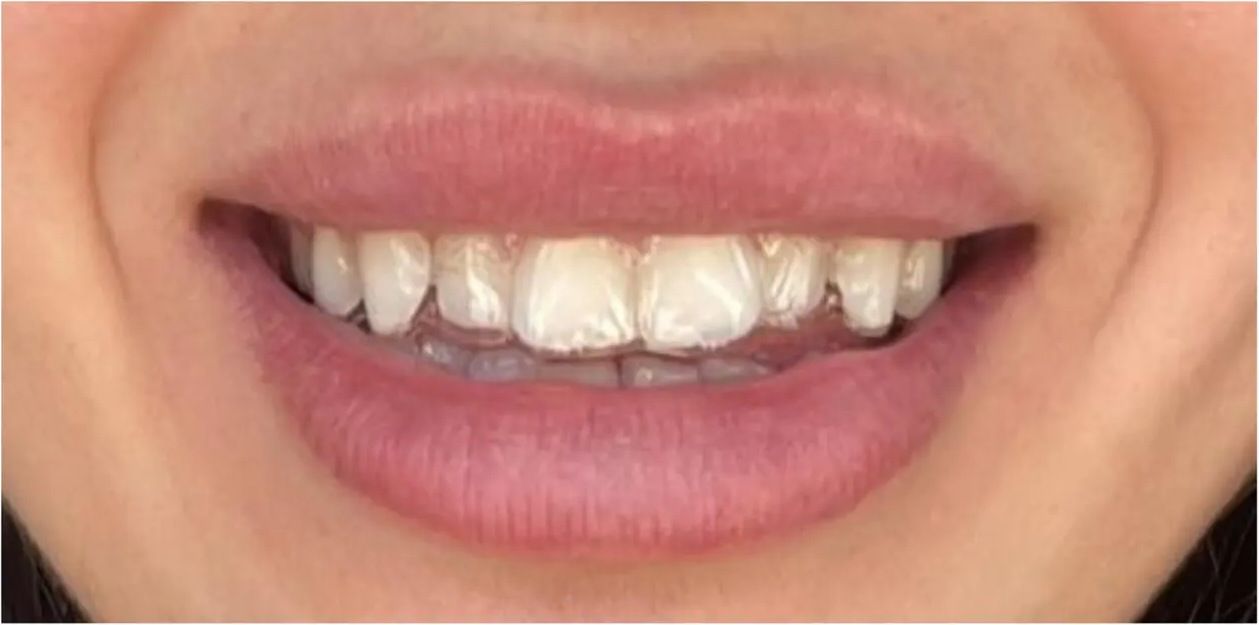 Before: uneven upper front teeth