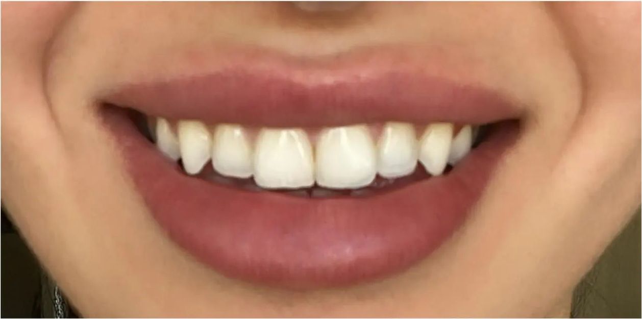After: the aligned front teeth