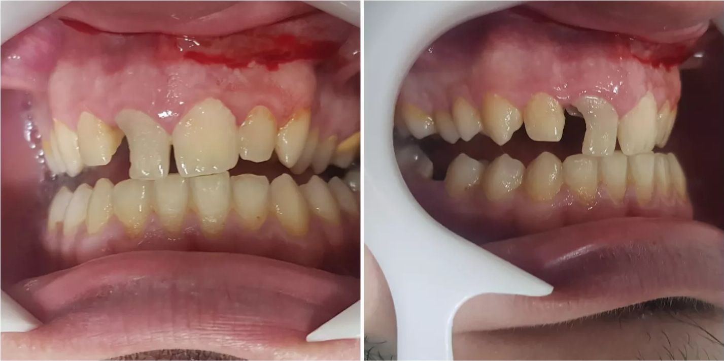 Before: gapped and broken upper front teeth