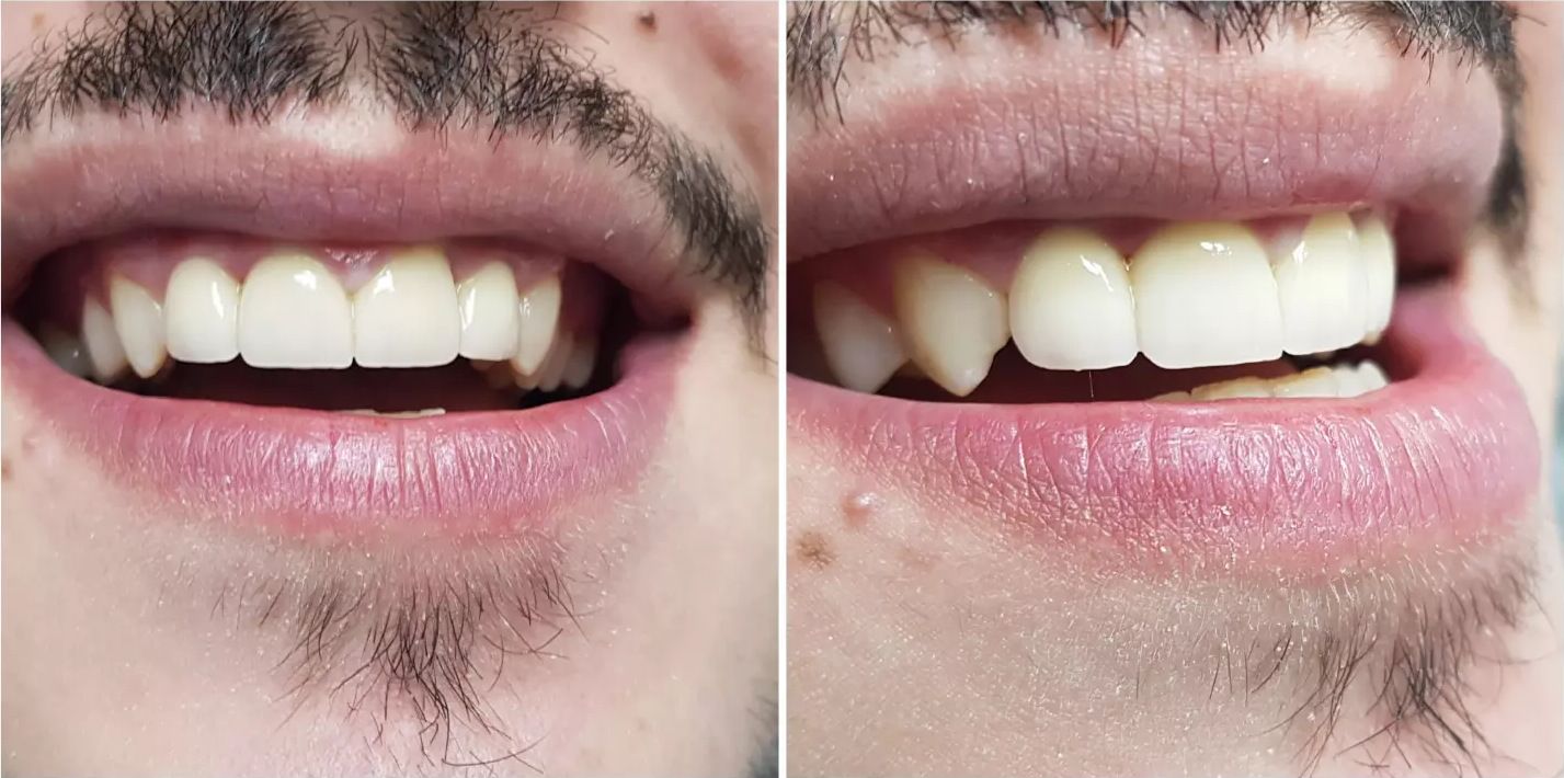 After: the restored front teeth