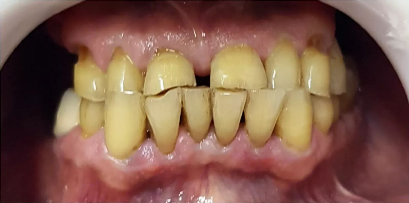 Before: worn and discoloured upper and lower teeth