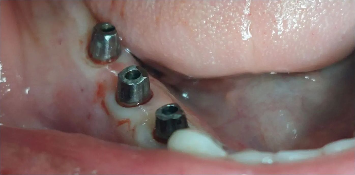 Implants placed: three implants in place in the back of the jaw