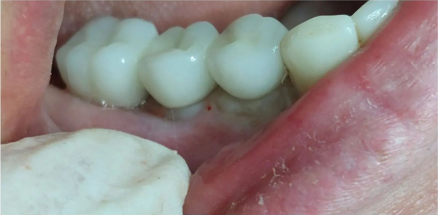 After: the implant-supported teeth fitted to them