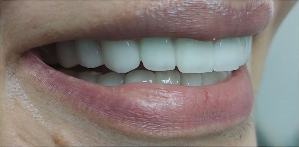 After: the same smile after restoration