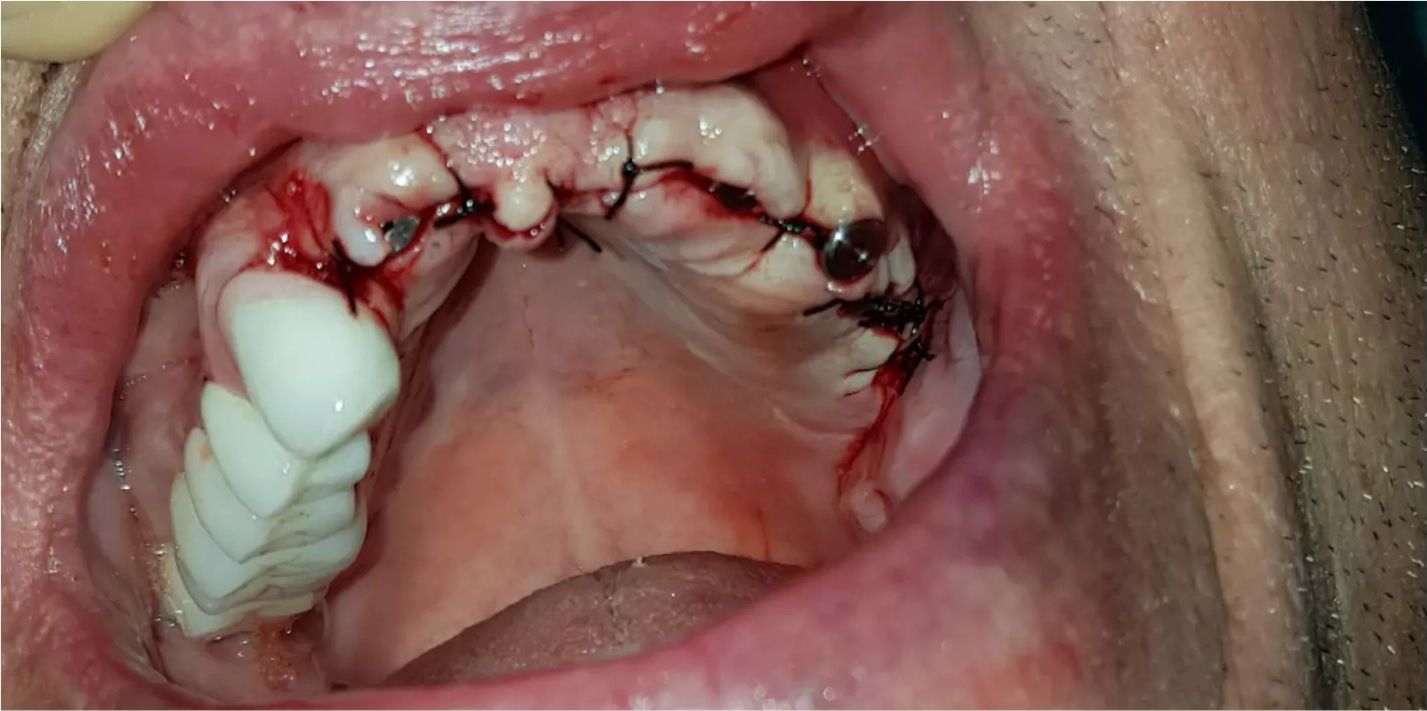 During treatment: an upper arch during implant treatment