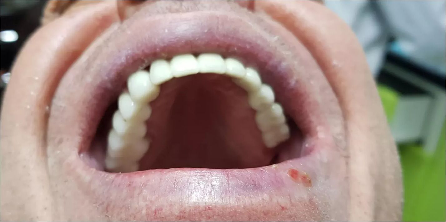 After: the completed implant-supported restoration