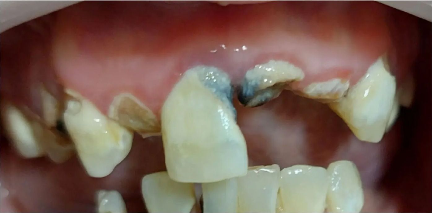 Before: damaged front teeth