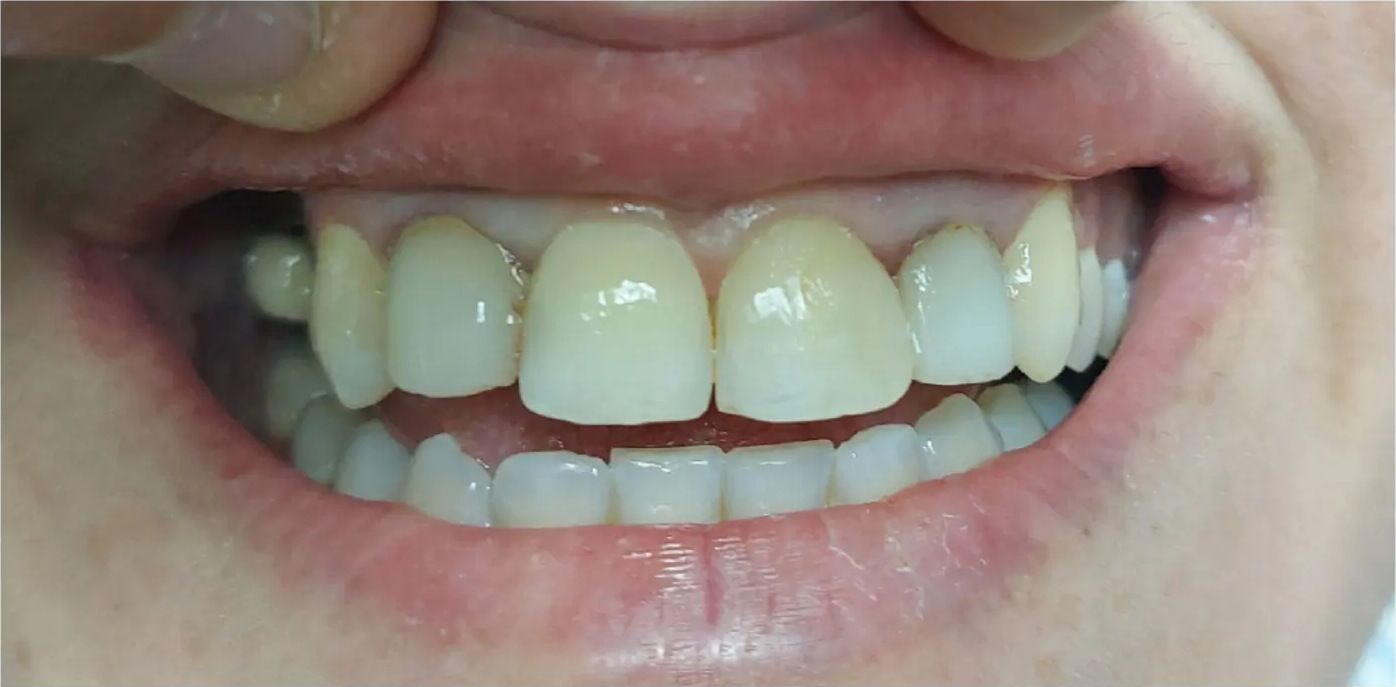 Before: a smile before treatment