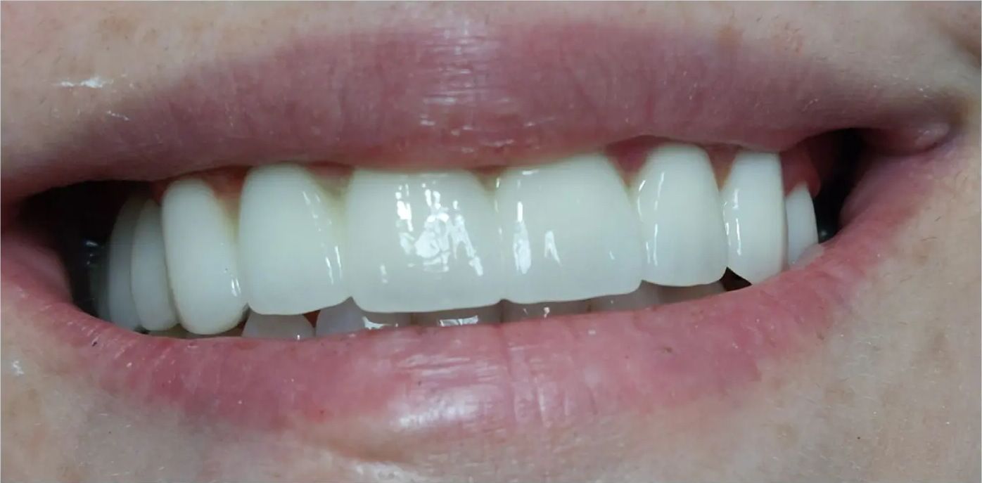 After: the smile after treatment