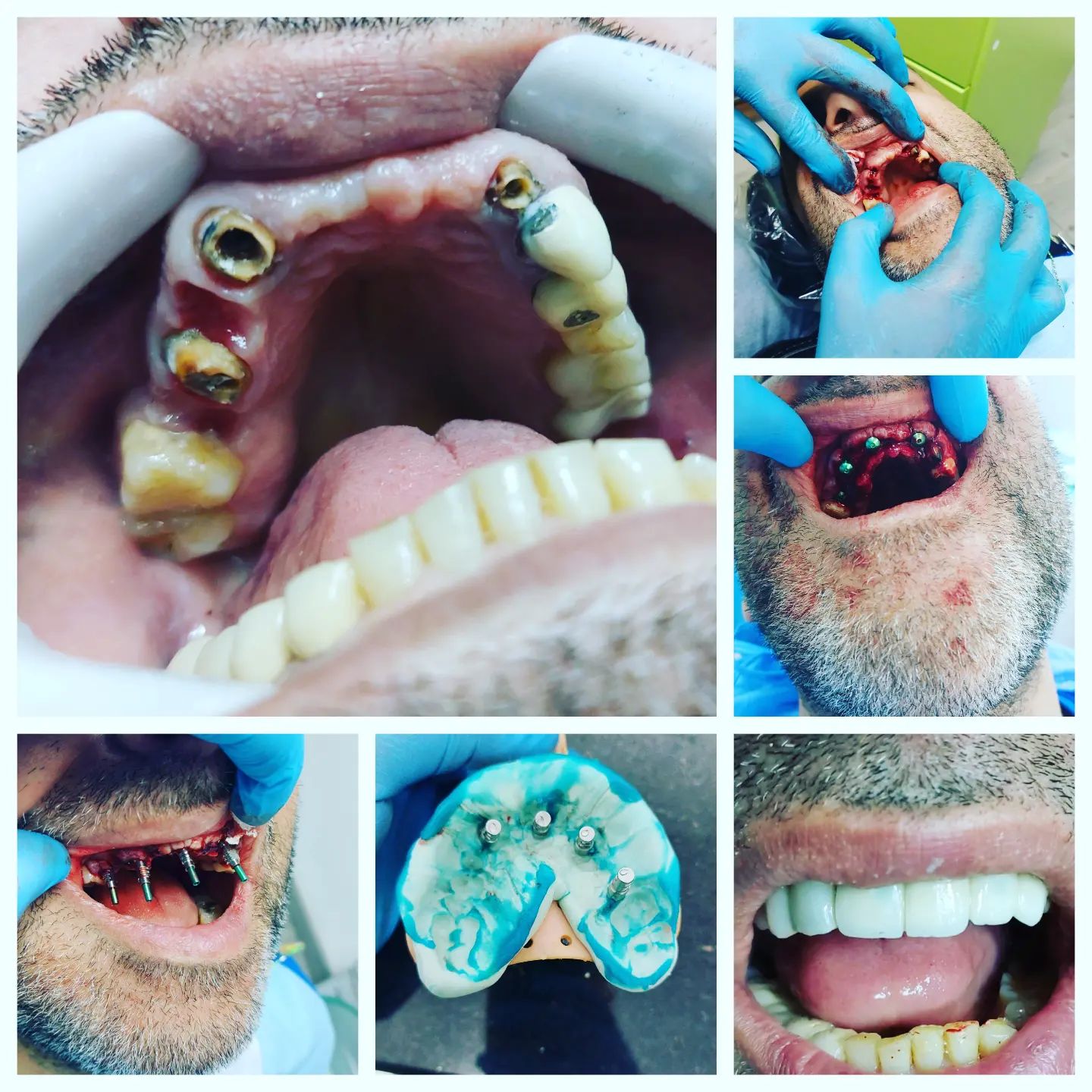 Stages of an immediate implant placement and same-day loading case