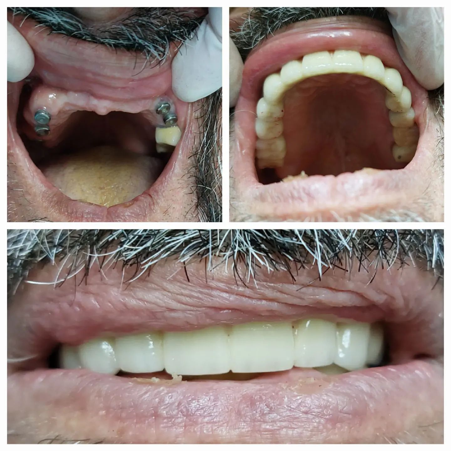 Implant case sheet showing implants in the jaw, the prosthesis and the final smile