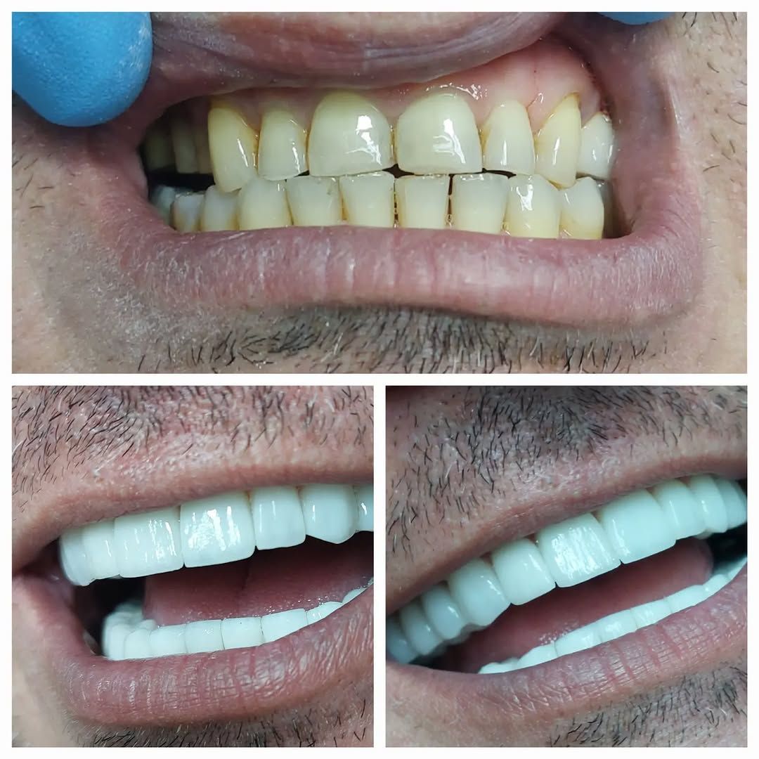 Smile makeover comparison with the smile before treatment above and two views after treatment below