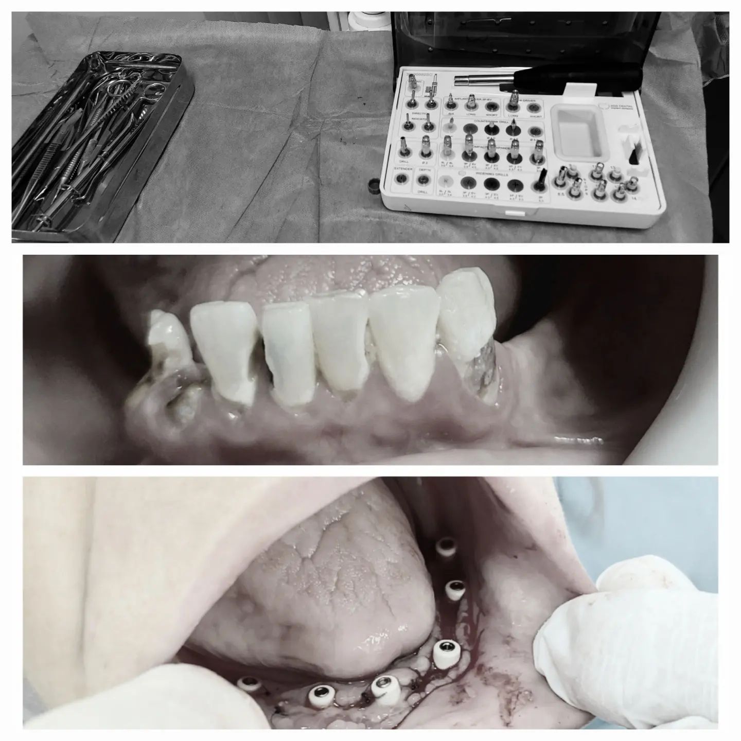 Implant surgical kit, the lower teeth before treatment, and implants in place in the lower jaw