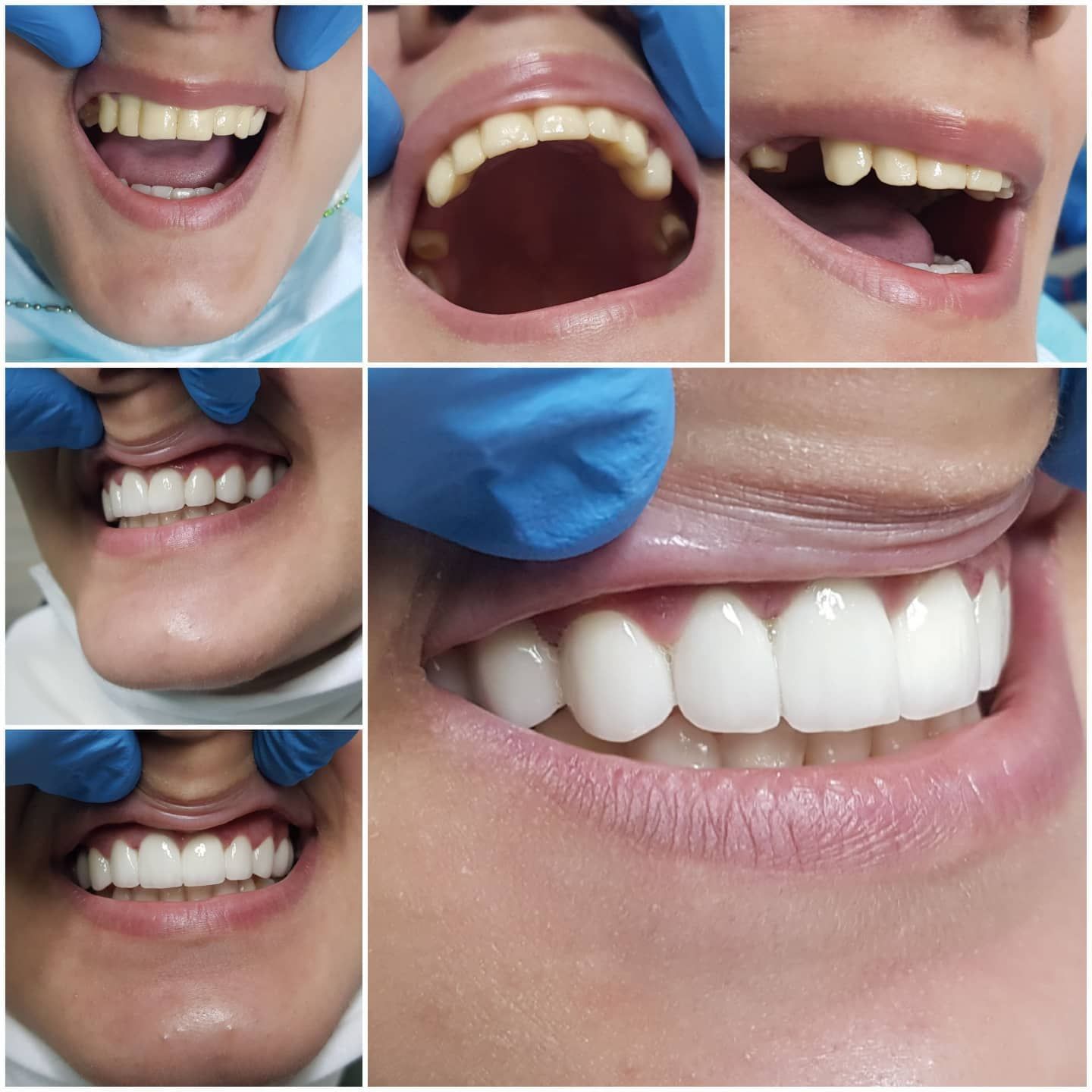 Collage of a veneer case photographed before and after treatment from several angles