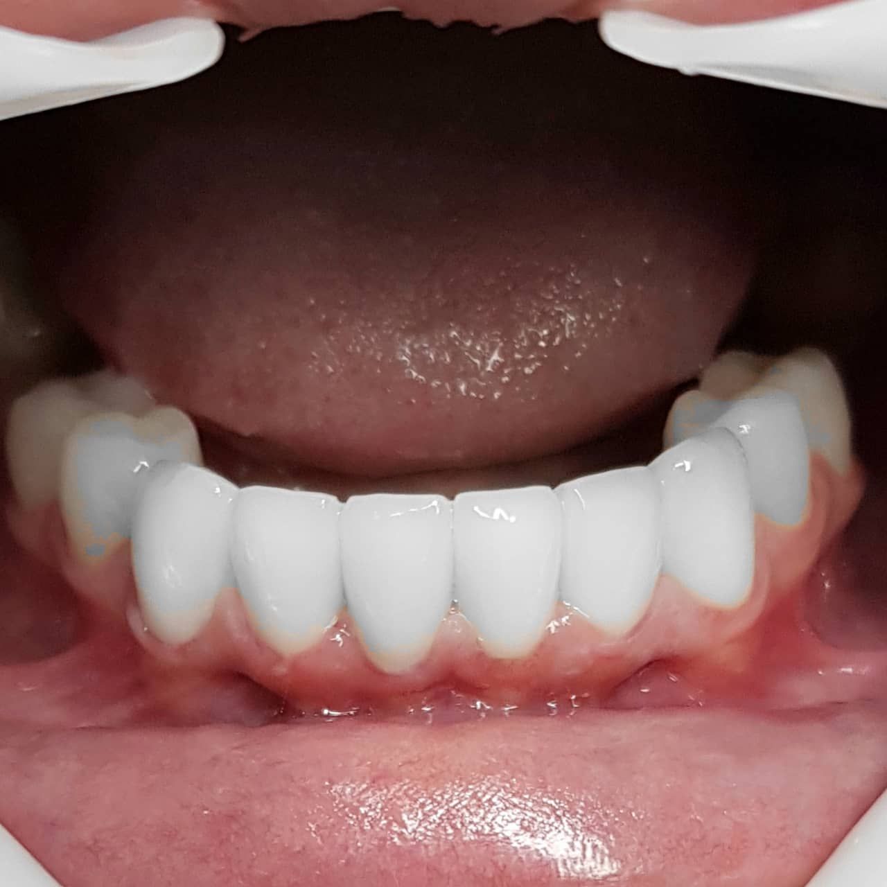 Finished veneer restoration on the lower front teeth