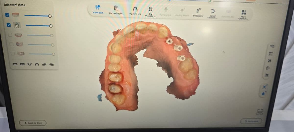 A digital scan of the teeth and gums on screen, with white markers showing the position of three implants
