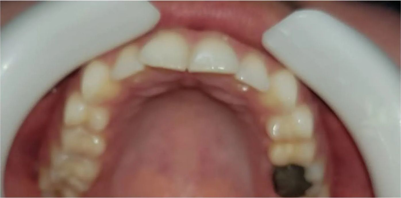 Before: the upper arch before treatment