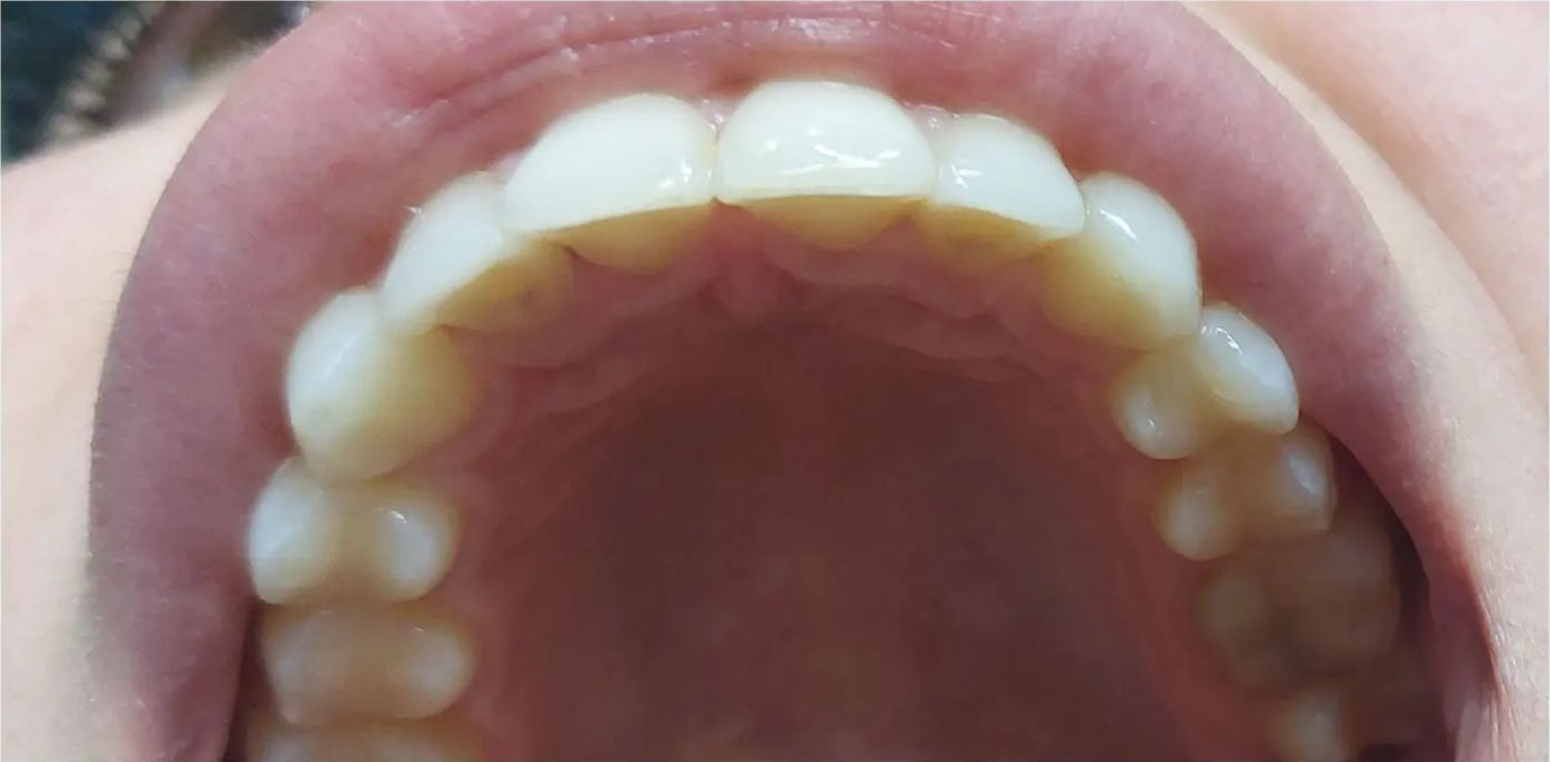 After: the upper arch after treatment