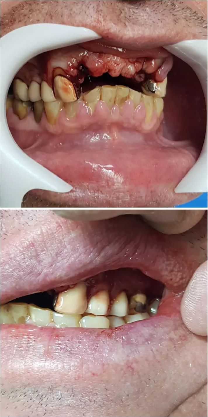 Before: broken and decayed upper teeth
