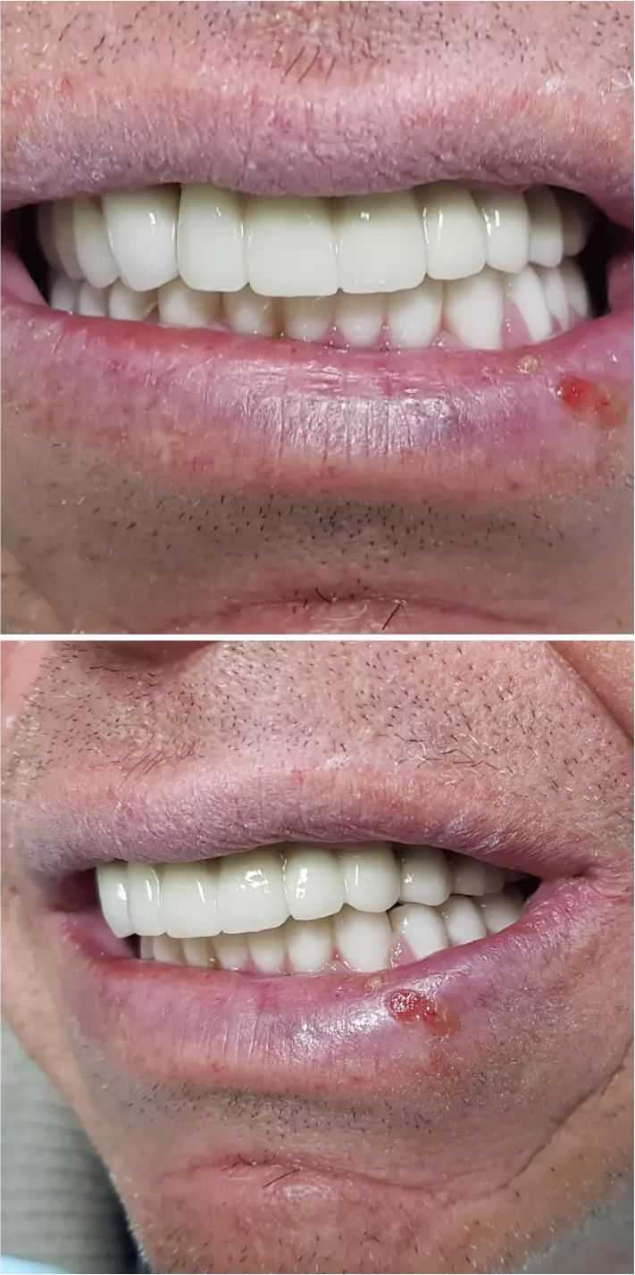 After: the restored upper teeth