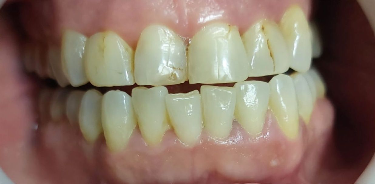 Before: worn and cracked front teeth before treatment