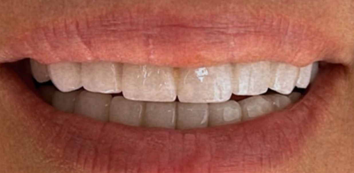 After: the restored smile after treatment